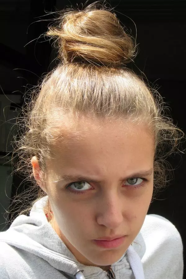 acné légère chez l'adolescente