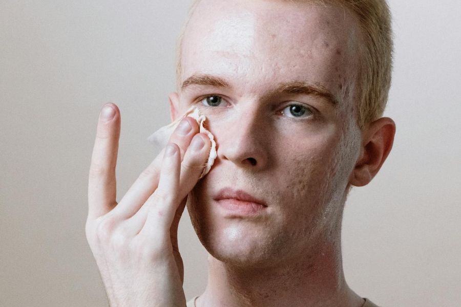 Acné soins à domicile-sosacne.fr