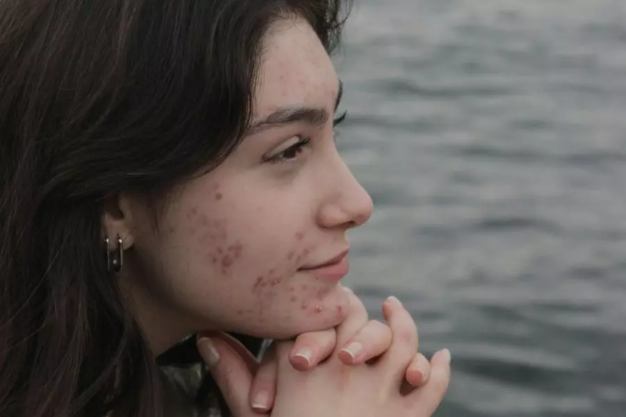 Les causes de l'acné