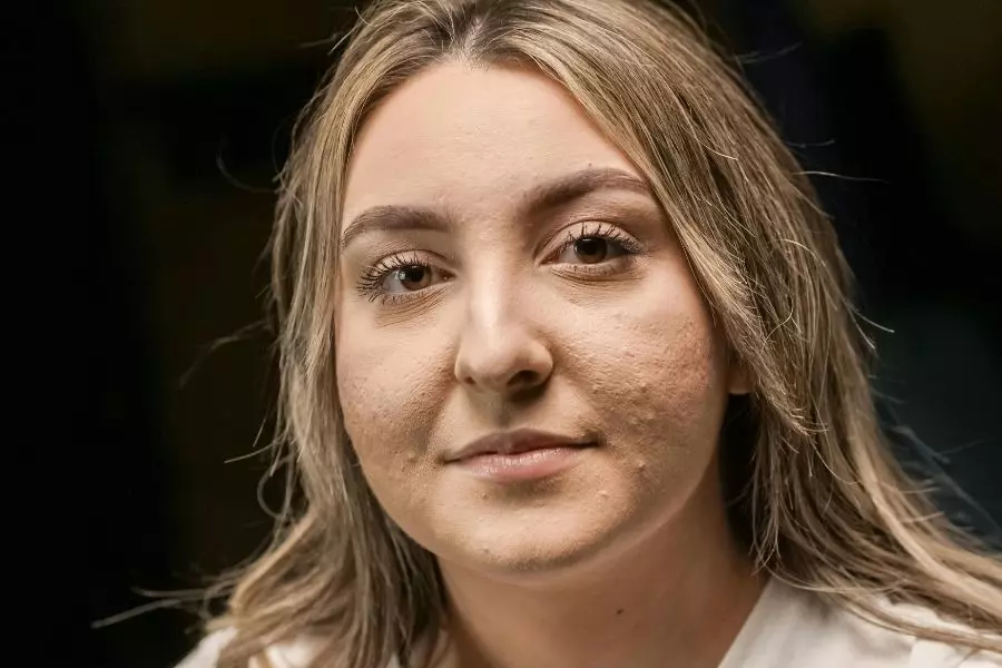 Reconnaitre l'acné-sosacne.fr