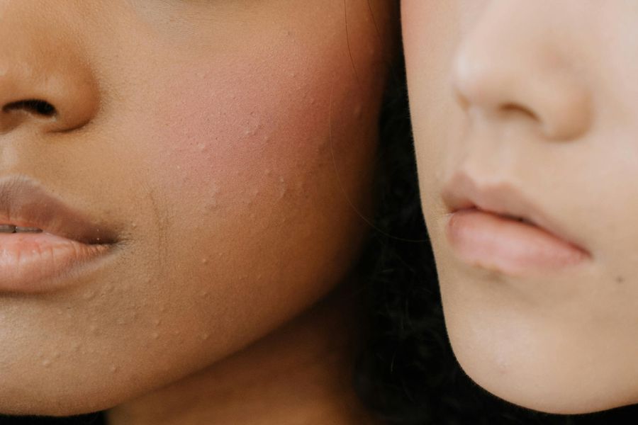 Vivre avec l'acné-sosacne.fr